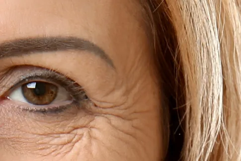 Botox για ρυτίδες έκφρασης ματιών από τον δερματολόγο Δρ. Νίκολαο Ζαπάρα Σέρρες