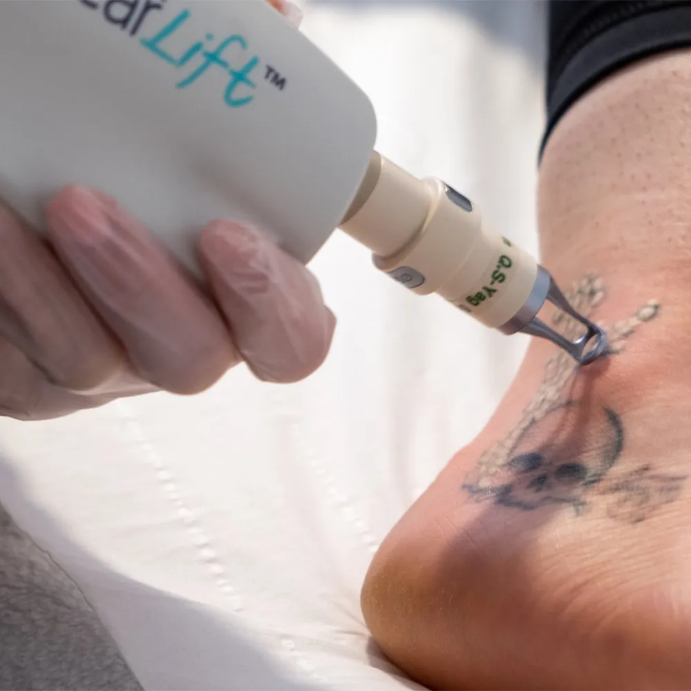 αφαίρεση tattoo τατουάζ με laser Σέρρες
