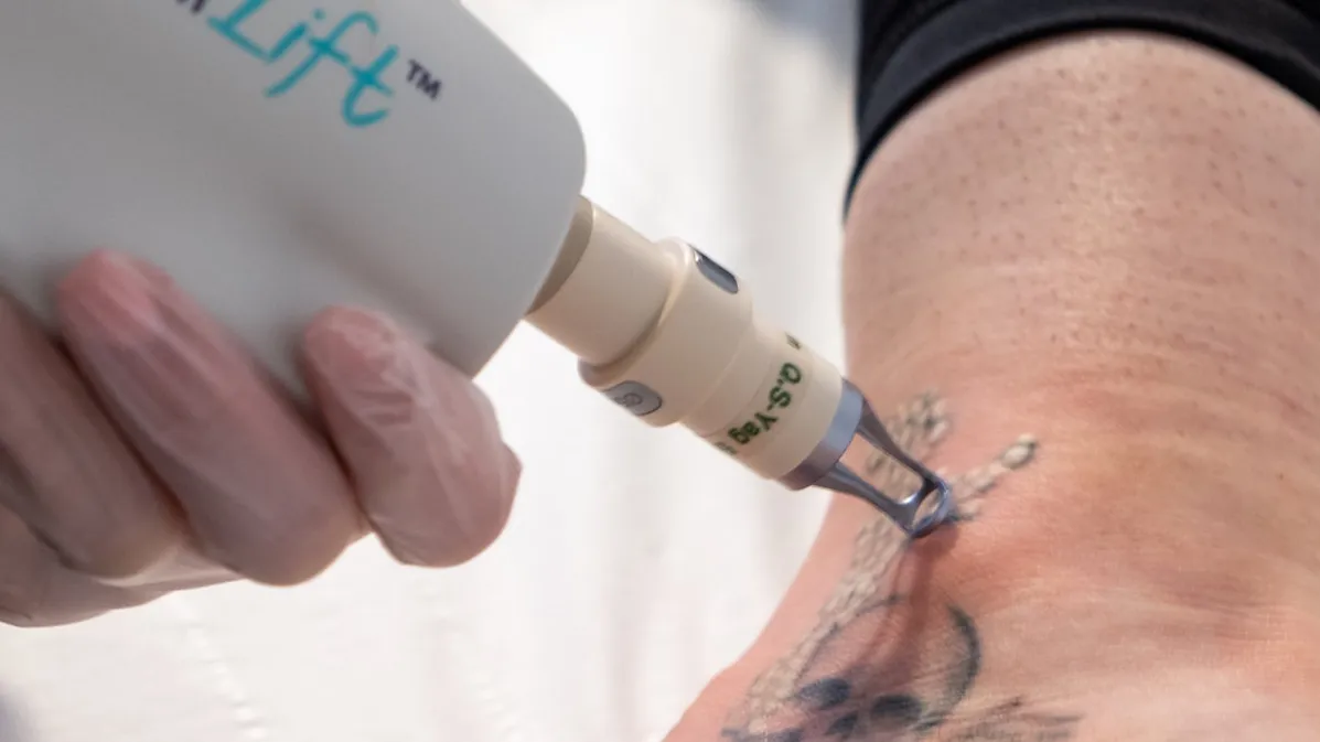 αφαίρεση tattoo τατουάζ με laser Σέρρες